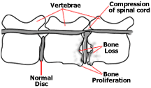 Side-view illustration depicting changes seen with diskospondylitis